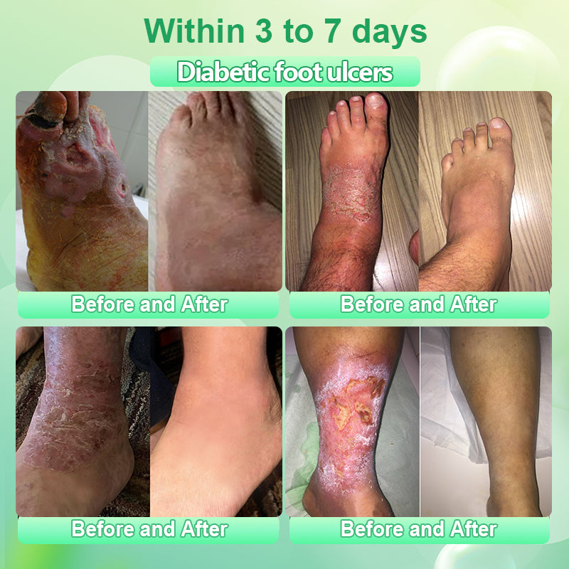 ADFIRE® Diabetic Skin Care Cream✅First Aid Healing Ointment, Natural Protective Ointment for Leg & Foot Ulcers, Venous Ulcers, Bed Sores, Pressure Sores and Septic Wounds