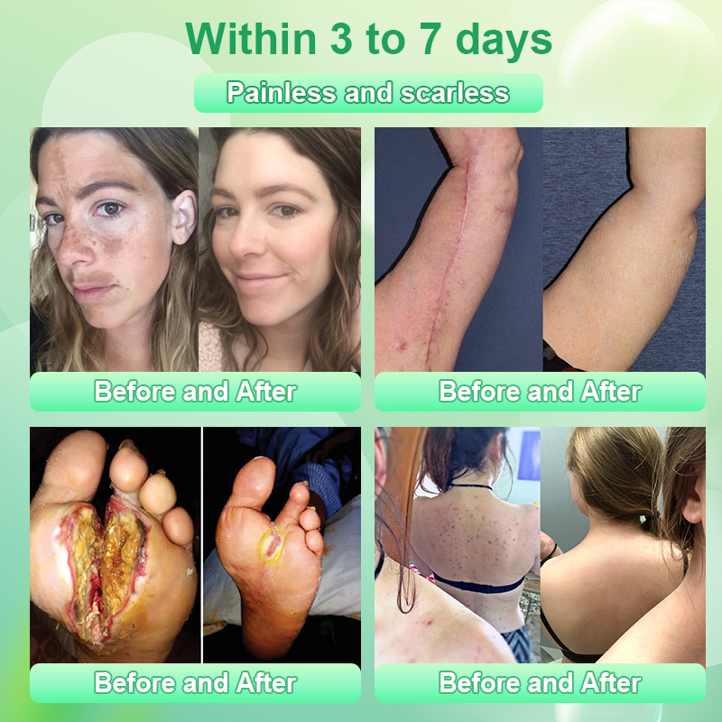 ADFIRE® Diabetic Skin Care Cream✅First Aid Healing Ointment, Natural Protective Ointment for Leg & Foot Ulcers, Venous Ulcers, Bed Sores, Pressure Sores and Septic Wounds