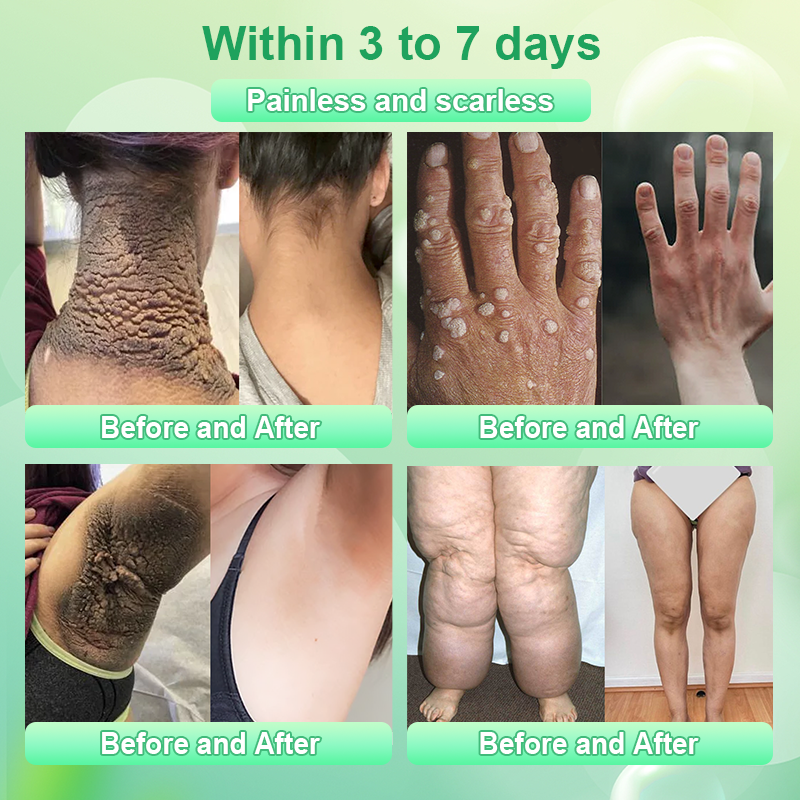 ADFIRE® Diabetic Skin Care Cream✅First Aid Healing Ointment, Natural Protective Ointment for Leg & Foot Ulcers, Venous Ulcers, Bed Sores, Pressure Sores and Septic Wounds