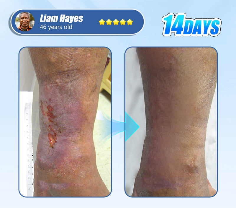 ADFIRE® Diabetic Skin Revolution – 6-IN-1 Clinical Solution 🦶 24H Flash Sale!