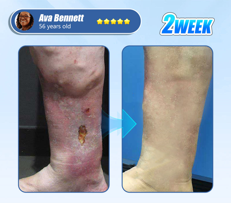ADFIRE® Diabetic Skin Revolution – 6-IN-1 Clinical Solution 🦶 24H Flash Sale!
