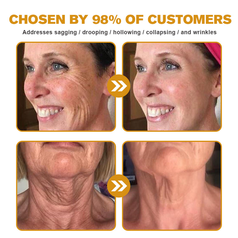 TLOPA®Botox Bee Venom Wrinkle Removal Cream👨⚕️ Laser & Skin Surgery Center Offical:- LAST DAY 80% OFF