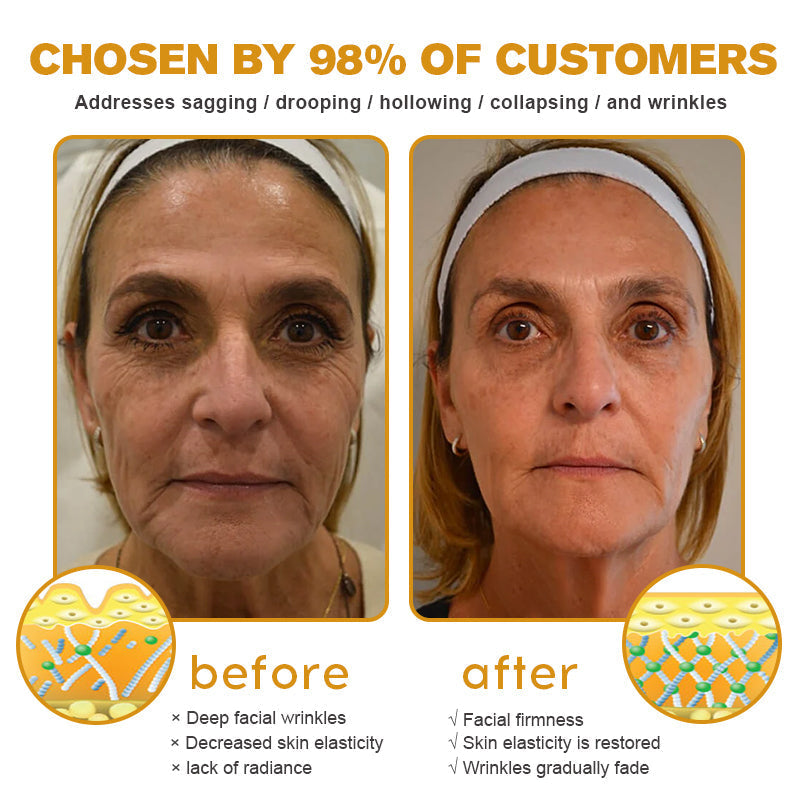 TLOPA®Botox Bee Venom Wrinkle Removal Cream👨⚕️ Laser & Skin Surgery Center Offical:- LAST DAY 80% OFF
