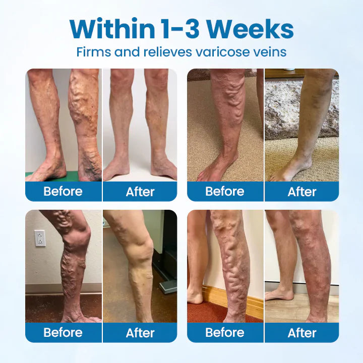 ADFIRE® VeinGuard Herbal Spray✅ Clinically proven to eliminate varicose veins in just 7 days!