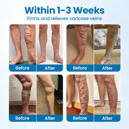 ADFIRE® VeinGuard Herbal Spray✅ Clinically proven to eliminate varicose veins in just 7 days!