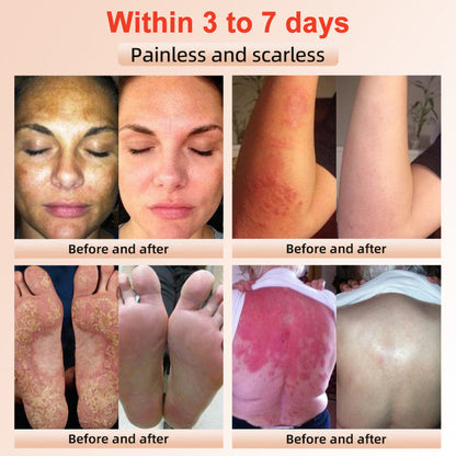 Purifying Exfoliating Gel for Acanthosis Nigricans, Exfoliation, Dark Spots, Skin Tags, and Eczema